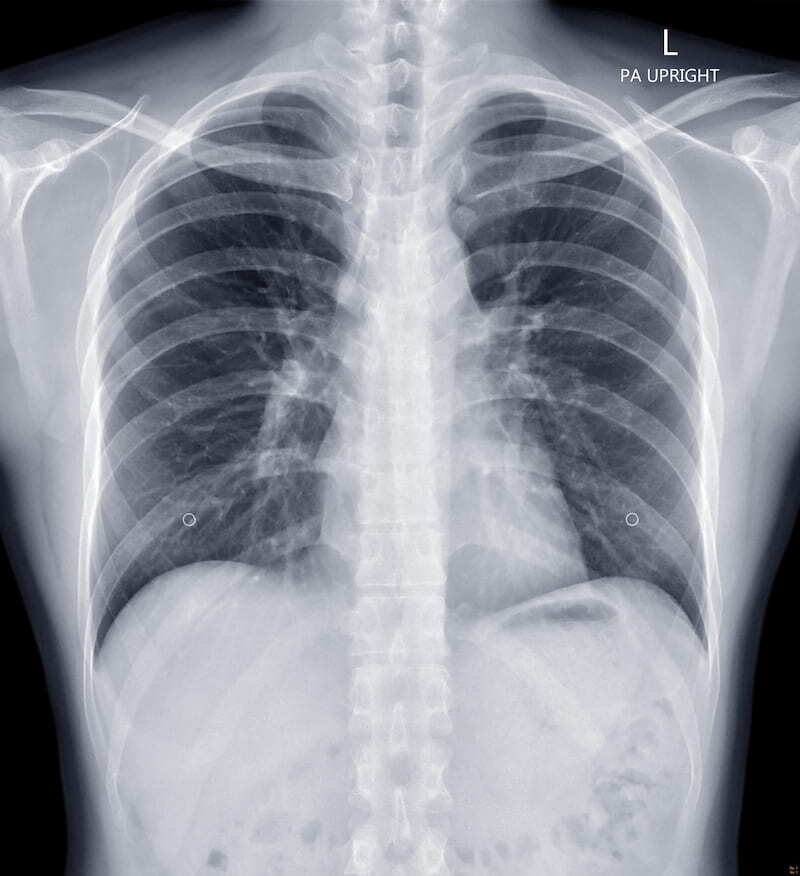 Evaluation of the ‘qXR’ Software for the Detection of Pulmonary Nodules, Cardiomegaly and Pleural Effusion: A Comparative Analysis in a Latin American General Hospital