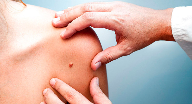 2 de cada 3 personas podría sufrir cáncer de piel