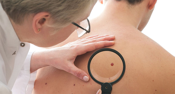 Señales de alerta de cáncer de piel