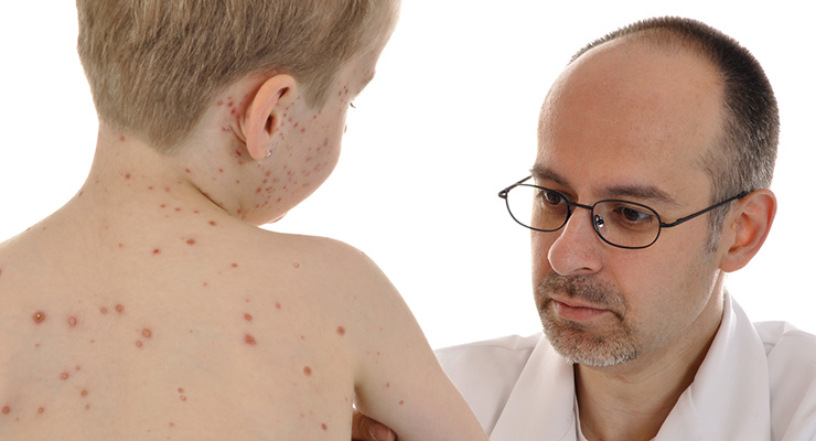 Fiebre, conjuntivitis y dolor de la garganta son síntomas del sarampión