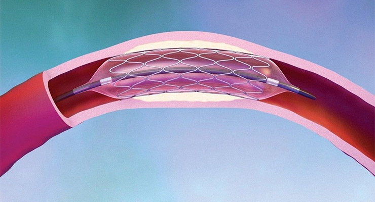 80% de las muertes súbitas se relacionan a enfermedad arterial coronaria