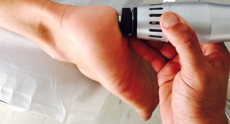 Espolón tratado en medicina biológica con terapia neural, biorresonancia y homeopatía