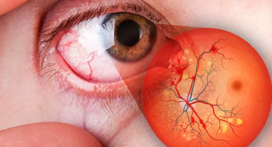 La retinopatía diabética es una complicación microvascular común de la diabetes, la cual puede llevar a ceguera.