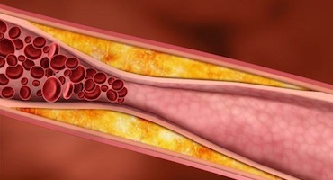 Qué es la arteriosclerosis?