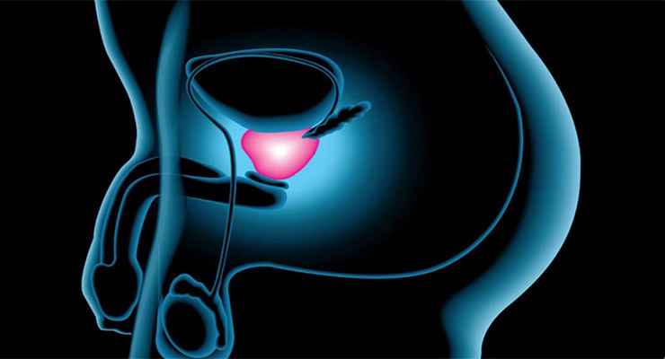 Cáncer de próstata