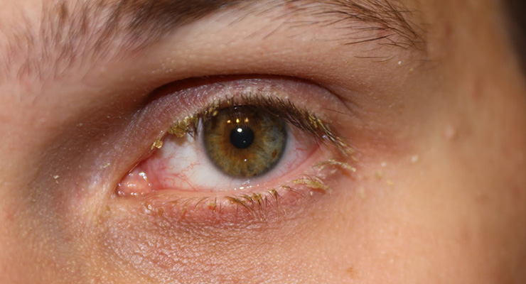 Conjuntivitis
