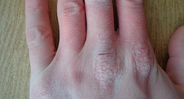 Dermatitis atópica Dermatitis atópica