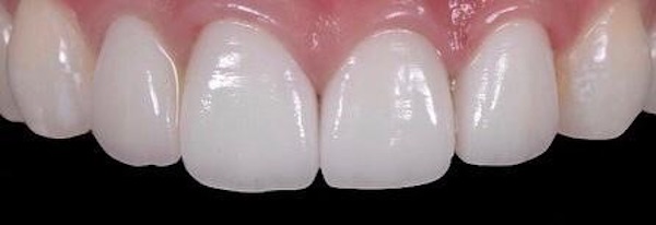 Rejuvenecimiento dental - Hospital Clínica Bíblica