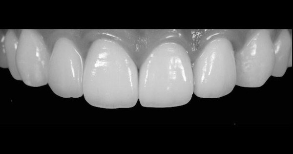 Rejuvenecimiento dental - Hospital Clínica Bíblica