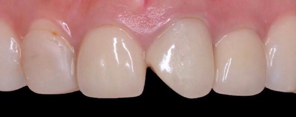 Rejuvenecimiento dental - Hospital Clínica Bíblica