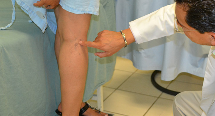 Varices